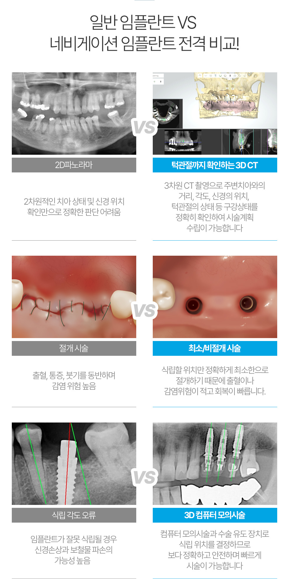 일반 임플란트 VS 네비게이션 임플란트 전격 비교!