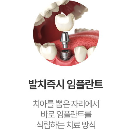 발치즉시 임플란트