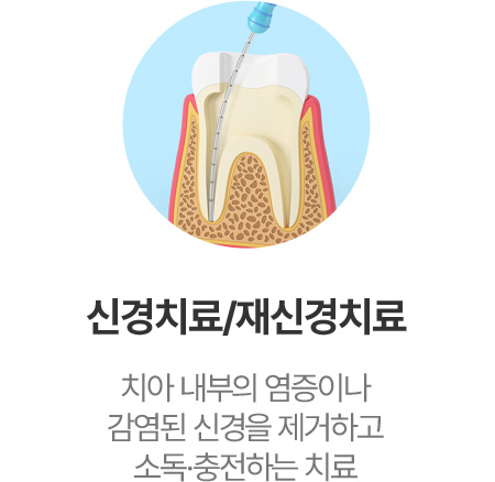 신경치료/재신경치료