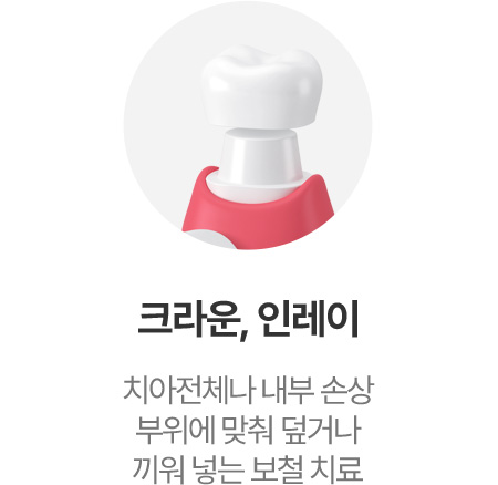 크라운, 인레이