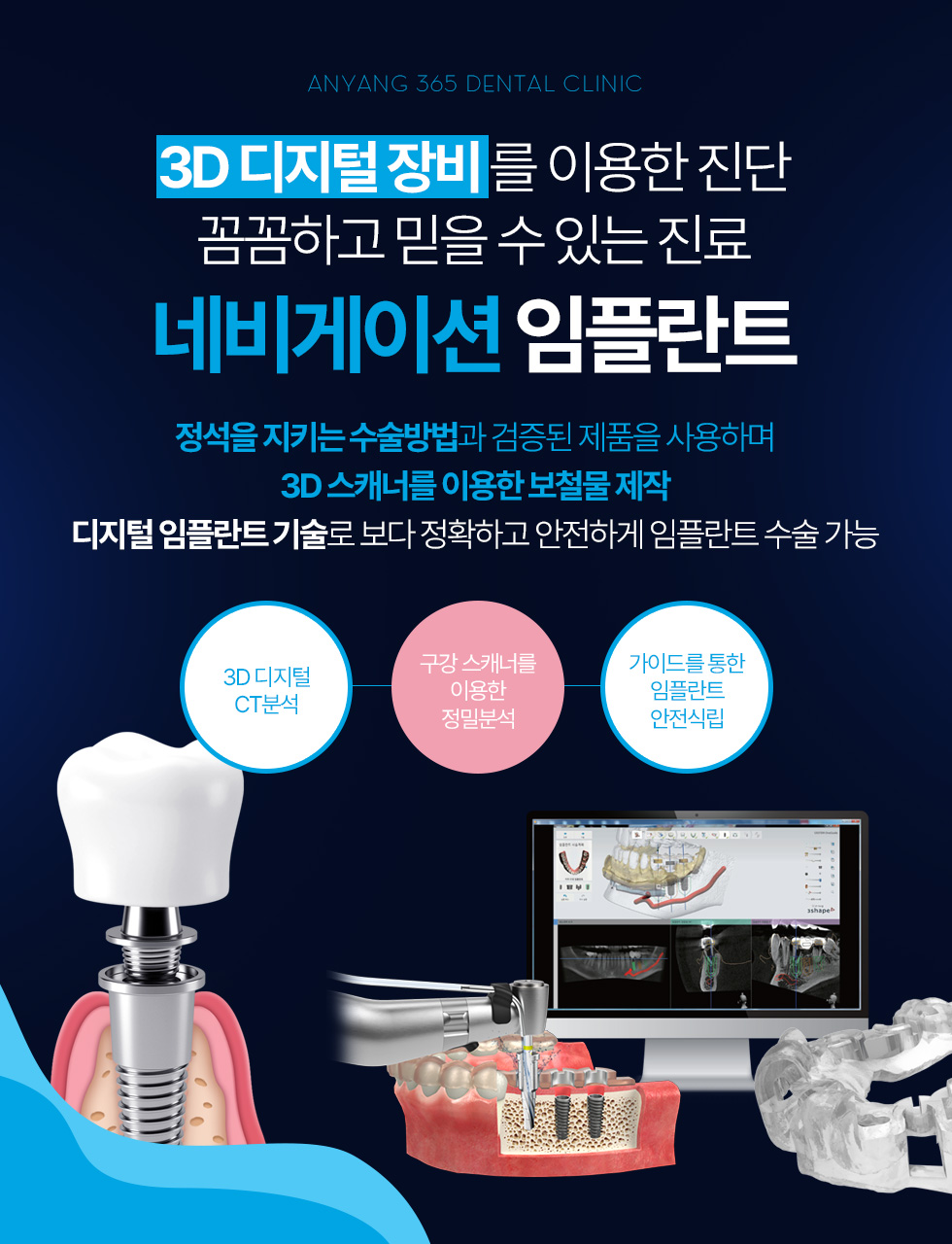 네비게이션 임플란트