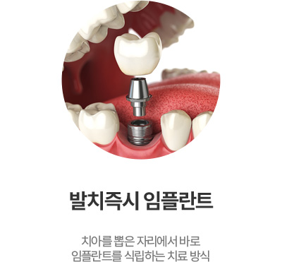 발치즉시 임플란트