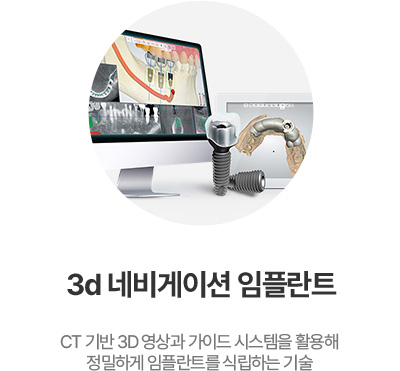 3d 네비게이션 임플란트