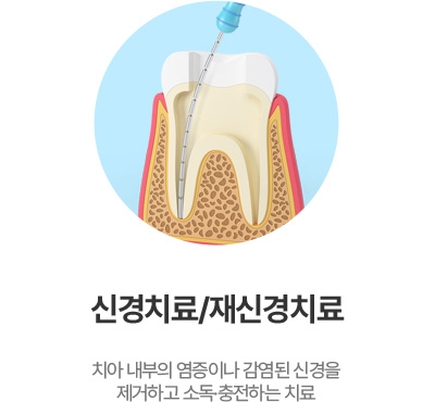 신경치료/재신경치료